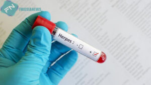 Kasus Herpes Zoster Singapura Meningkat